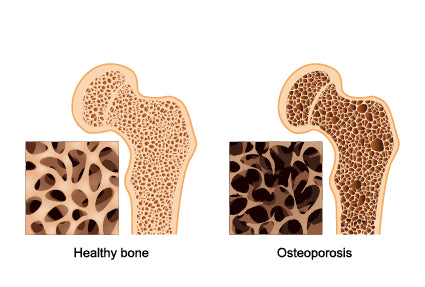 Does Rebounding increase bone density?