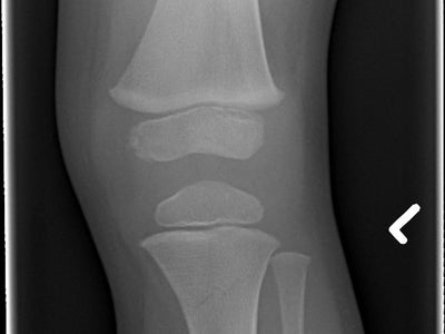 The Cons of Rebounding: Safety & Potential Risks